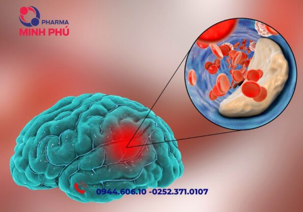 Nguyên nhân dẫn tới đột quỵ ngày càng trẻ hóa là do đâu?